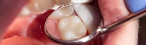 Descubre el empaste dental y sus utilidades